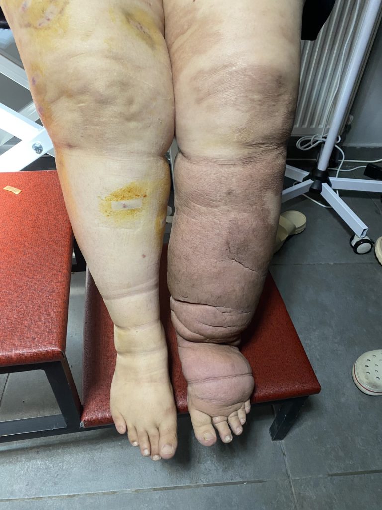 Selülit ve lipodem bulgusu