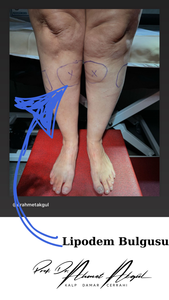 Selülit ve lipodem bulgusu